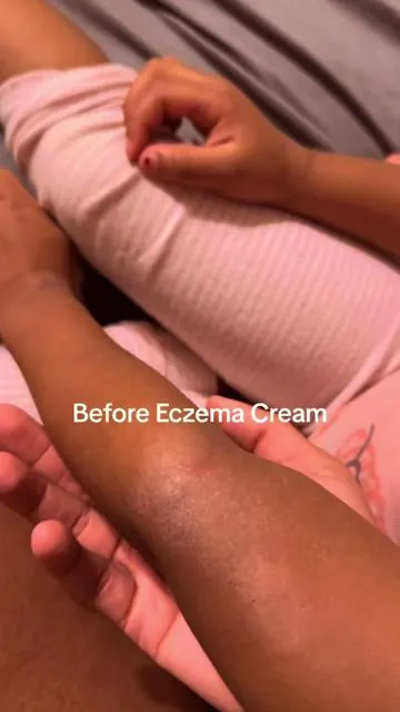 If you have eczema, please try this. After just 48 hours of using this on my daughter, you can see less dryness & redness. She is also less fussy & itchy. Worth every penny! Hurry before sale ends. #eczema #seamoss #theoceanhealedmyeczema #eczemaawareness #dryskin