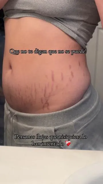 Que no te digan que no se puede! Eliminacion de estrias crema #eliminaciondeestrias #estrias #cream #tiktok #producto #lomejor #todoelmundo #blanqueamiento @MAËLYS #maelys #mujeres #hombres 