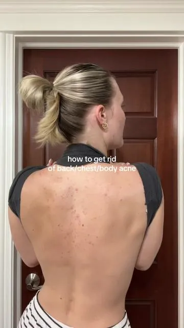 I swear by this body acne routine 🙌🏻 #backacne #bodyacne #cysticacne #acnetreatment #tiktokshop 