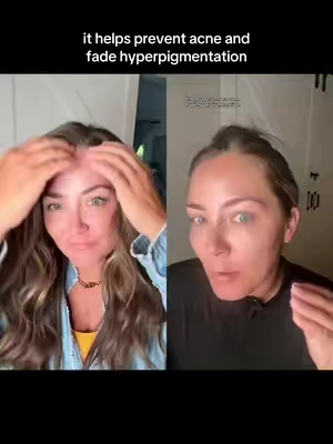 #duet with @haleystyle #a313 my best kept secret that I don’t keep a secret lol LOVE #a313cream #skincareforacne #TikTokshopbacktoschool #tiktokshopfinds #retinol #vitamina 