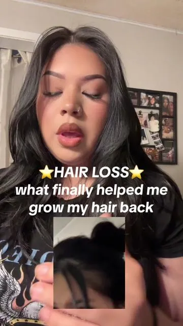 Honestly its kind of embarrassing showing my bald spots (  I never thought oh let me snap some pics of my bald spots ) so this is why i dont have many but i wanted to share this incase anyone out there is also struggling with bald spots wether its postpartum like me or just natural causes I REALLY REALLY RECOMMEND THIS ⭐️👏🏼 currently on my second bottle🫢🥰 #hairloss #hairlossremedy #immediateresults #hairgrowth #hairgrowthtips #hairgrowthjourney 