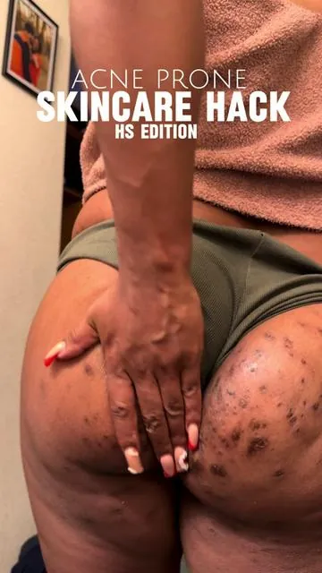 Imperfect skin is innnn 🙌🏾✨ #mymagichealerpartner #Hidradenitissuppurativa #hswarrior #hsawareness #hidradenitissuppurativawarrior #socialcydd #livingwithhs 