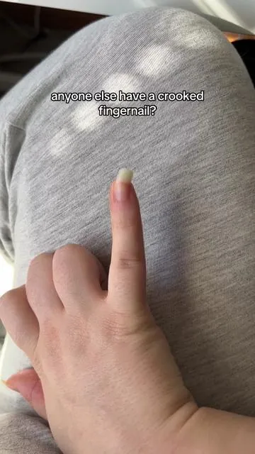 anyone else have a crooked fingernail? #nailoil #nailgrowthoil #radiantcosmetics #fingernails #naturalnails #falldealsforyou #tiktokshopblackfriday #tiktokshopcybermonday #tiktokshopholidayhaul 