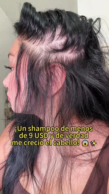 El #champú que me recomendó mi amigo doctor es realmente bueno. Los amigos con #caída de cabello severa deben probarlo.#hairgrowth #antihairfall #bald