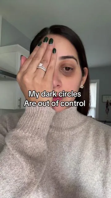 I’ve struggled with dark circles my whole life. This eye brightner by dermatology has been a game changer for my no make up days #eyebrightener #drmtlgy #darkcirclesundereyes #darkcircles #undereyecircles 