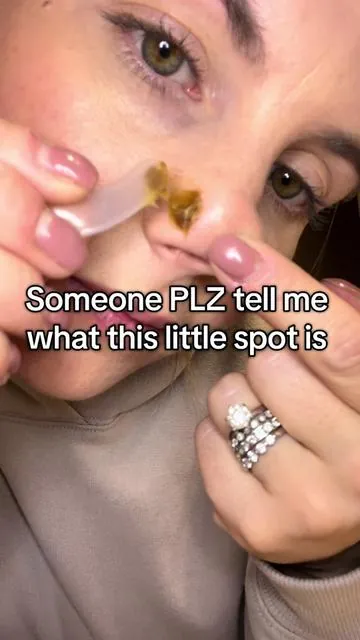 Hylands naturals PRID cream! Let’s see! Great for ingrown hairs, splinters, acne you name it. Someone please  tell me what this spot is. #hylandsnaturals #hylandsprid #prid #splinter #ingrownhairs 