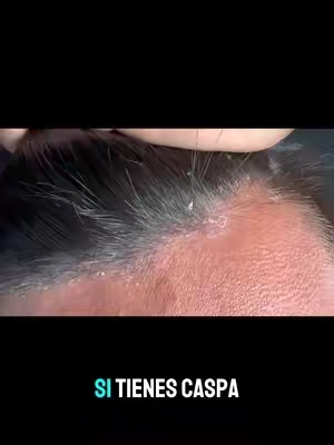 #caspa #caspa #caspa #caspa #caspa #caspa #tratamiento #tratamiento #bueno #barato #bueno #barato #bueno 
