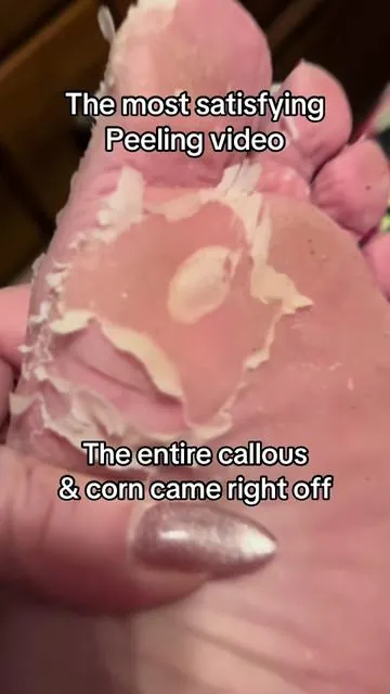 #FootPeel #Callous #CallusRemoval #DryFeet #DrySkin #CrackingFeet #Peeling #Satisfying 