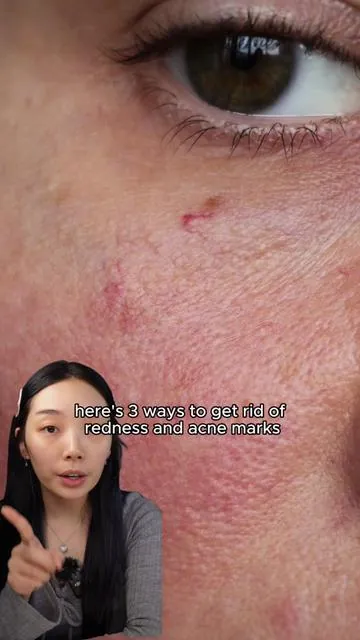 the new anua azelaic acid has been one of my recent favorites for calming redness and its SUPER lightweight so i highly recommend it for people who dont like sticky serums. And this one is not available on oliveyoung so make sure to get it on tiktok shop or amazon! #anuapartner #anua #anuaserum #anuaskincare #enlargedpores #skincaretiktok #glassskin #kbeauty #skincaretip #skincareroutines #skincareempties #kbeautyfinds #kbeautyproducts #koreanskincaretips #koreanskincaretiktok #koreanbeauty #skincareforbeginners #glowyskincare
