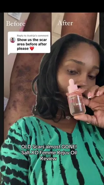 Replying to @Audrija #greenscreen new scars and old scars dont stand a chance. Our femme rejuv oil is for your coochie but you can use it on scars too! #greenscreen #saltxo #femininehygiene #hygienetips #femininehygiene 