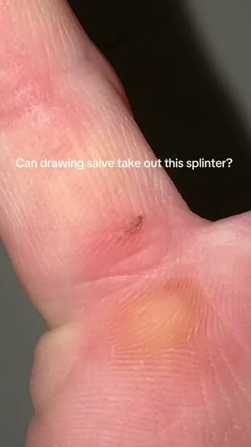 I actually can’t believe it 🤯 This drawing salve made it so easy to just push this splinter out! This is going to help so many different things!  #prid #drawingsalve #splinter #splinterremoval 