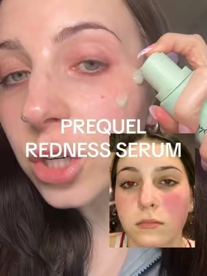 redness reform serum vs rosacea- this stuff is UNREAL.  ✨ reduces redness and irritation ✨ helps the skin barrier This stuff is a godsend for my redness honestly  @Prequelskin  #prequel #prequelskin #prequelskincarereview #prequelrednessserum #rednessserum #rosacea #rosaceaskincare #rosaceaskincaretips #rednesscorrector #rednessrelief #skincare #skincarerecommendations #serum #skincareserum #affordableskincare #affordableskincareproducts #tiktokshopnewarrivals #ttsbeautybesties #beautybesties #tiktokshopcreatorpicks #tiktokshopspringglowup #springglowup #rednessreform #rednessreformserum 