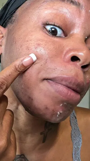 Never have I ever had a product that works this well 🔥 #skincare #skincareroutine #chemicalpeel 