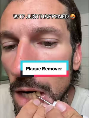 I was not expecting that! #plaqueremoval #dentalhygiene #cleanteeth #teethcleaning #tiktokshopcreatorpicks 