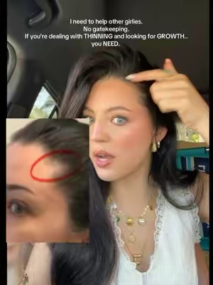 THE BEST DUO FOR HEALTHY HAIR GROWTH! 💯🔥 Idk how I was walking around missing half my hairline before 🥲😅 oh also! The oil lasts me 6 months! And the water based serum about 3 to 4 months!  #hairgrowth #hairline #recedinghairline #thinninghair #thinninghairsolution #thickerhair #hairtips #hairserum #hairtok #healthyhair #hairgrowthtips #hairgrowthoil #hairgrowthproducts #widowspeak  #monattiktok #longhair 