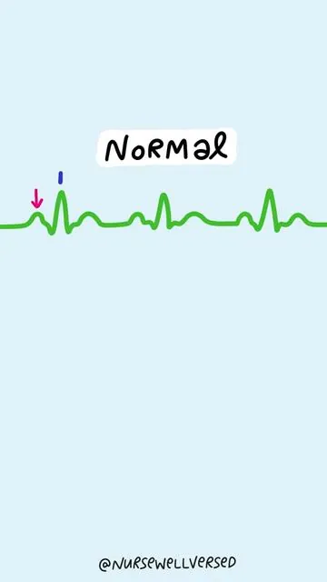🫀 Heart Blocks A heart block happens when there’s a delay or interruption in the electrical conduction that controls the heart’s rhythm. Here are the 4 types you need to know: 🔹 1st Degree → PR interval is prolonged 🔹 2nd Degree Type I (Wenckebach) → PR gets progressively longer, then drops a beat 🔹 2nd Degree Type II (Mobitz II) → PR is consistent, but some QRS complexes are randomly dropped ⚠️ Highest risk of progressing to 3rd degree 🔴 3rd Degree (Complete Heart Block) → No communication between atria and ventricles → P waves and QRS complexes “march” independently 🚨 Medical emergency! Comment below if you’ve heard the heart block poem before! #nursingschool #nursingstudent #nursingeducation #nursingstudentsoftiktok #nclexrn #futurenurse #futurenursesoftiktok #nursetiktok #nursingmajor #nursingtiktok #nursing #cardiology #nclexreview #nclex #heartblock