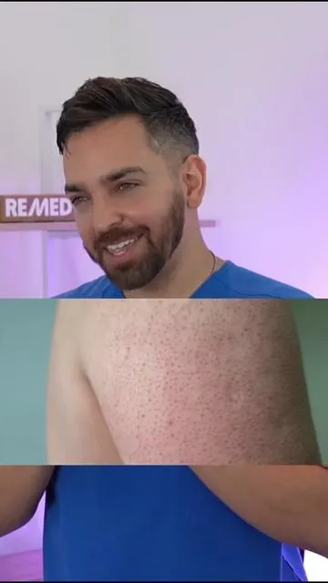 KP is one of the hardest to treat. Be patient and make sure to wear sunscreen during the summer #remedyscience #keratosispilaris 