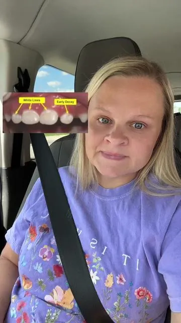 Life changing toothpaste and I found it on Tik Tok shop! I paid for it with my own money and have loved this company ever since. #nobs #toothpaste #cavity #hypoplasia #remineralizeyourteeth #enamel #dentist #dental #oralhealth #oralcare 