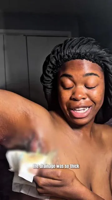 OK y’all 🤭 you know I had to pop out with a storytime about @MyMagicHealer 💛✨because my honest opinion on Universal Flare Care?  ✨ICONIC 🐝🍯✨ Listening back to this video after editing brought up those emotions again. Just remembering the relief I felt. Like..I could finally move my arm again. At one point, I couldn’t even put on a bra. That’s how bad my flare was 🙌🏾💜 I’m so grateful their team reached out and showed me not just how to use it, but how to care for my skin in a new way. Watching the healing process unfold was surreal 🤍 I never thought something could make this kind of difference in my life 🫶🏾 If you’ve been struggling with flares and haven’t tried The Universal Flare Care yet… this might just be the product your skin has been waiting for 👏🏾 You deserve to feel relieved, relaxed, and reconnected to your body in a way that feels empowering ✨💜 #HidradenitisSuppurativa #MyMagicHealer #HSCommunity #UniversalFlareCare #ChronicSkinCondition #HSWarrior #BodyPositivity #HSRelief #LifeWithHS #SkincareSupport #SkinStorytime #hsadvocate 