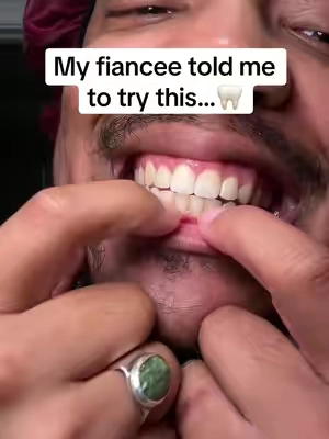 No whitening strips just a good toothpaste that makes your teeth nice and white using niacinamide #bodyacceltoothpaste #bodyacceltripelwhiteningtoothpaste #bodyaccel #toothpaste #teethwhitening #Niacinamide #whiteningtoothpaste 