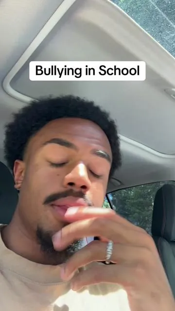 Being bullied in school about your hairline is not for the weak… #hairline #bully #hairtransplant 
