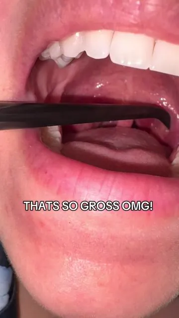 My tonsil stones have never been removed this easy before! #flosserwaterteeth #tonsilstones 