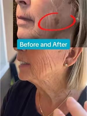 The magical ingredient to help with age spots, dark spots, sun, spots, hyper pigmentation, and melasma is the GoPure vitamin C. It is the highest percentage of vitamin C to really get to work on those trouble areas! #vitamincserum #agespots #melasma #hyperpigmentation #sunspots 