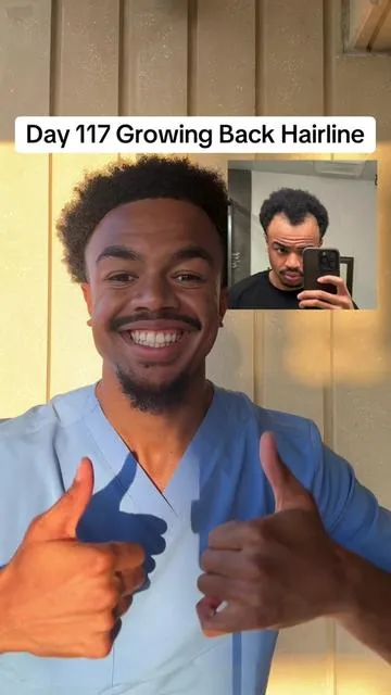 Day 117 growing back my hairline, we’re making progress!! #hairline #hairregrowth 