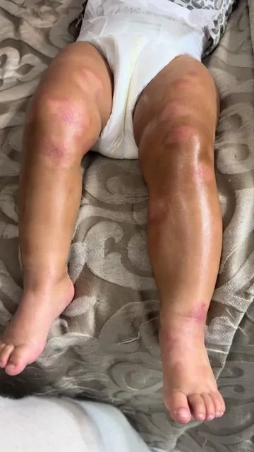 I truly was so overwhelmed with this whole eczema situation weeks ago if you know you know.  Only parents who have kids with eczema will understand it’s so hard watching your baby scratch and scratch until they bleed and they can’t control it because they are literally babies. It’s so sad waking up in the morning and seeing your baby’s sleeping bag full of blood from them scratching. I unfortunately, have two that have eczema. It’s literally the worst. I’m so glad that I found something that can help calm down her eczema. No, it will not get rid of it, but at least it helps, calm down the flare ups. ##eczema##eczematok##eczemaawareness##babieswitheczema##dermatologist##godisgood##skin##allergies##allergist##itchy##rash##inflamedskin##eczmaproblems##guthealth