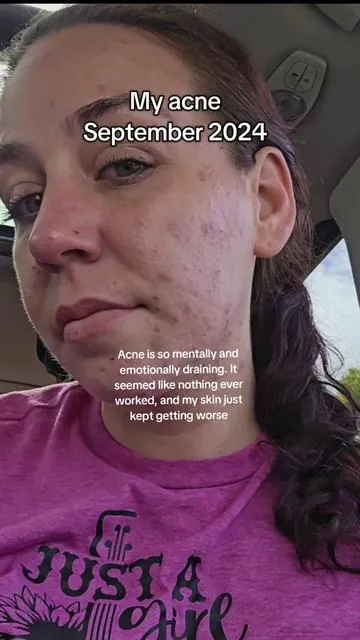 acne mental health is a whole different level of mental health  🙌 what helped you clear your acne? #creatorsearchinsights #acnementalhealth #acneproneskin #acnejourney #acnetips #acneskincare #acnetreatment #acneprevention #antiagingskincare #hormonalhealth #hormonalimbalance #acne #skincaretips #skincare  @CLEARSTEM Skincare 