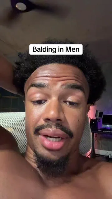 Balding usually begins around 25-35 if you’re lucky… #hairregrowth #bald 