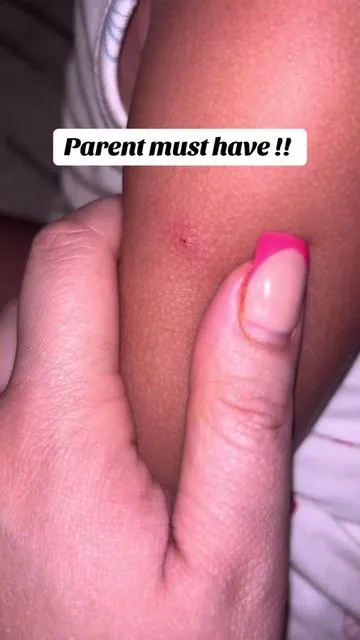 This “bug bite thing” is genius !! #bugbitething #mosquitobiterelief #beestingrelief #parentmusthaves 