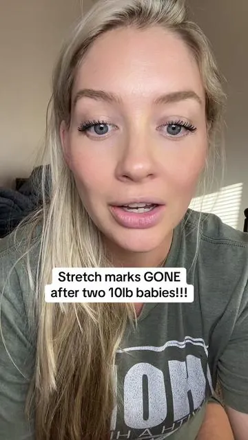 Two 10 lb babies. Home births. Zero shame. I earned my tiger stripes—but beef tallow helped fade them fast. It’s pregnancy-safe, toxin-free, and actually works to nourish damaged skin + rebuild elasticity. I use it daily on my belly, hips, and even old stretch marks. Moms deserve real results without the chemicals. #NaturalSkincare #PostpartumHealing #StretchMarkRemedy