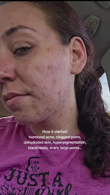 my hormonal acne use to be out of control until I found this supplement 🙌 @CLEARSTEM Skincare  #hormonalacne #acneskincare #acnetreatment #acneprevention #antiagingskincare #antiagingtips #hormonalacnejourney #hormonalimbalance #hormonalhealth #acneproneskin #acnejourney #acnefighter #fyp #foryoupage #fupシ 