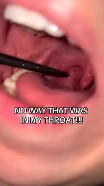 Something nice has helped remove my tonsil stones! ##flosserwaterteeth##tonsilstones