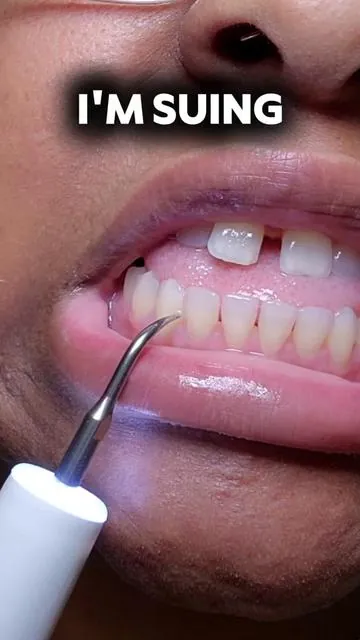 #dentist #teeth #cleanteeth #plaque ##plaqueremoval  #dentalhygiene #teethcleaning #dealsforeveryyou 
