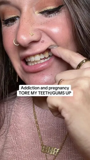 Addiction and pregnancy tore my teeth up. I was embarrassed to smile. Everything hurt. I used to coat my teeth in AQUAPHOR just to create a barrier 😩 But now? Dentite Tooth Armor is my go-to. It actually protects my enamel, feels soothing, and stays put. This stuff is saving my smile, one day at a time. #oralhealth #sensitiveteeth #MomLife #HealingEra #wedorecover 