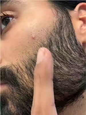 PSA: Popping your pimples can lead to scarring, try this instead! #pimples #acne #menskincare #skincare 