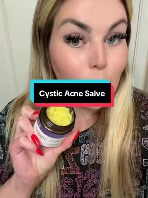The Universal Flare scare from @MyMagicHealer is a game changer for HS and cystic acne. #mymagichealer #hidra #hs #hidradenitissuppurativaawareness #boils #cysticacne #cysticacnetreatment #universalflarecare #skinsalve #pcos #pcosproblems 