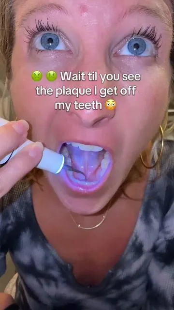 I can't believe I'm posting this.. raw footage of me removing plaque with this electric plaque remover. Please still go see your dentist.  #oralcare #plaqueremover #teethcare #tiktokshopcreatorpicks #dentalcare 