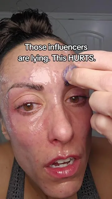 If you're in your 30s and starting to notice fine lines, this at-home microneedling kit might actually be worth it. I was NOT ready for how painful it was—but the results? My forehead lines and 11s almost disappeared. Qure’s micro-infusion system seriously tightened my skin, and it’s on MAJOR sale right now. Real results, no influencer filter. #over30skincare #fineLines #antiagingroutine #qureskincare #realreview 