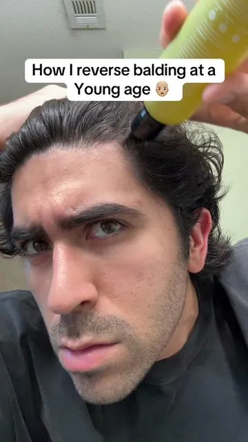 How I reversed my balding by using this hair growth serum #tiktokshop #tiktokmademebuyit #lebanta #hairgrowth #balding @Lebanta Haircare 