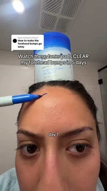 Replying to @Emily6 Korean toner pads are the reason my forehead bumps are GONE!! I have super sensitive skin and they’ve been SOOO gentle but effective 💕 #tonerpad #skintok #acne #koreanskincare #tiktokshopcreatorpicks 