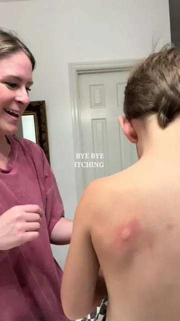 Best $10 I’ve spent @Bug Bite Thing  #bugbitething #bugbitethingsuctiontool #bugbitethingbeforeandafter #bugbiterelief #mosquitobites #mosquitohack #tiktikshop #tiktokshopfinds #tiktokshopdeals 