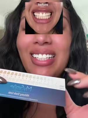 OH MY GAHHHHH look at how much my teeth whitened in 10 MINUTES 🥹🦷✨ @MySmile_US #mysmile #dentalgradeteethwhitening #teethwhitening #yellowteeth #tiktokshopcreatorpicks 