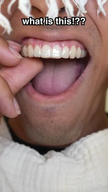 This is why you should clean your retainers 😁 #gurunanda @GuruNanda LLC @Puneet Nanda bridge the gap #viral #fyp #transformation #routine 