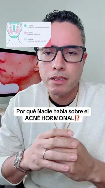 Por qué nadie habla sobre el acné Hormonal ⁉️ #acnehormonal #skin #dim 