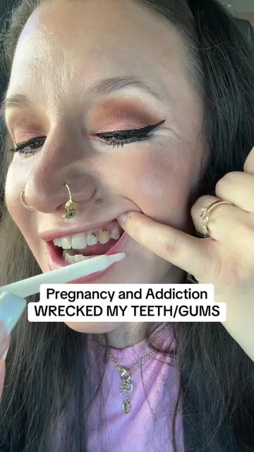I ditched fluoride + drugstore pastes for Dentite Tooth Armor 🦷 ozonated oils + hydroxyapatite = strong enamel, balanced pH, fresh breath — naturally. My gums have never been happier. ✨ Disclaimer: These are my opinions. Please check reviews, do your own research, and make informed decisions as results may vary!! #hydroxyapatite #HolisticWellness #oralhealth #TikTokShopCreatorPicks #pregnancyproblems 