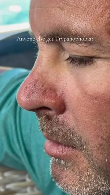 Medicuve peel shot now has hypochlorous acid in it which kills bacteria and sterilizes the skin. Great for blackheads and whiteheads. #medicubesuperbrandday #medicube #peelshot #exfoliante #tiktokshopcreatorpicks @medicube US Store 