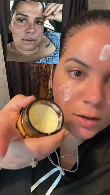 #manchasenlapiel#ceboderes#melasma#whippedtallowhoneybalm#tiktokshop 